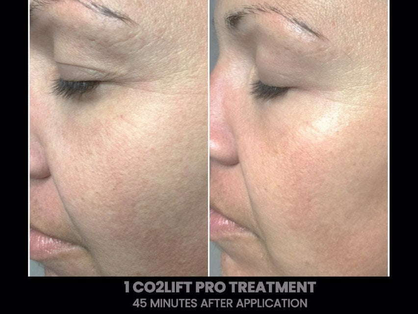 CO2 Lift Pro Carboxy Gel Treatment