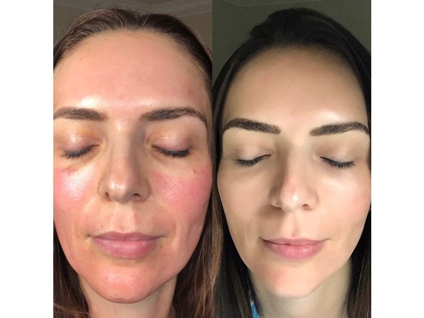 CO2 Lift Pro Carboxy Gel Treatment